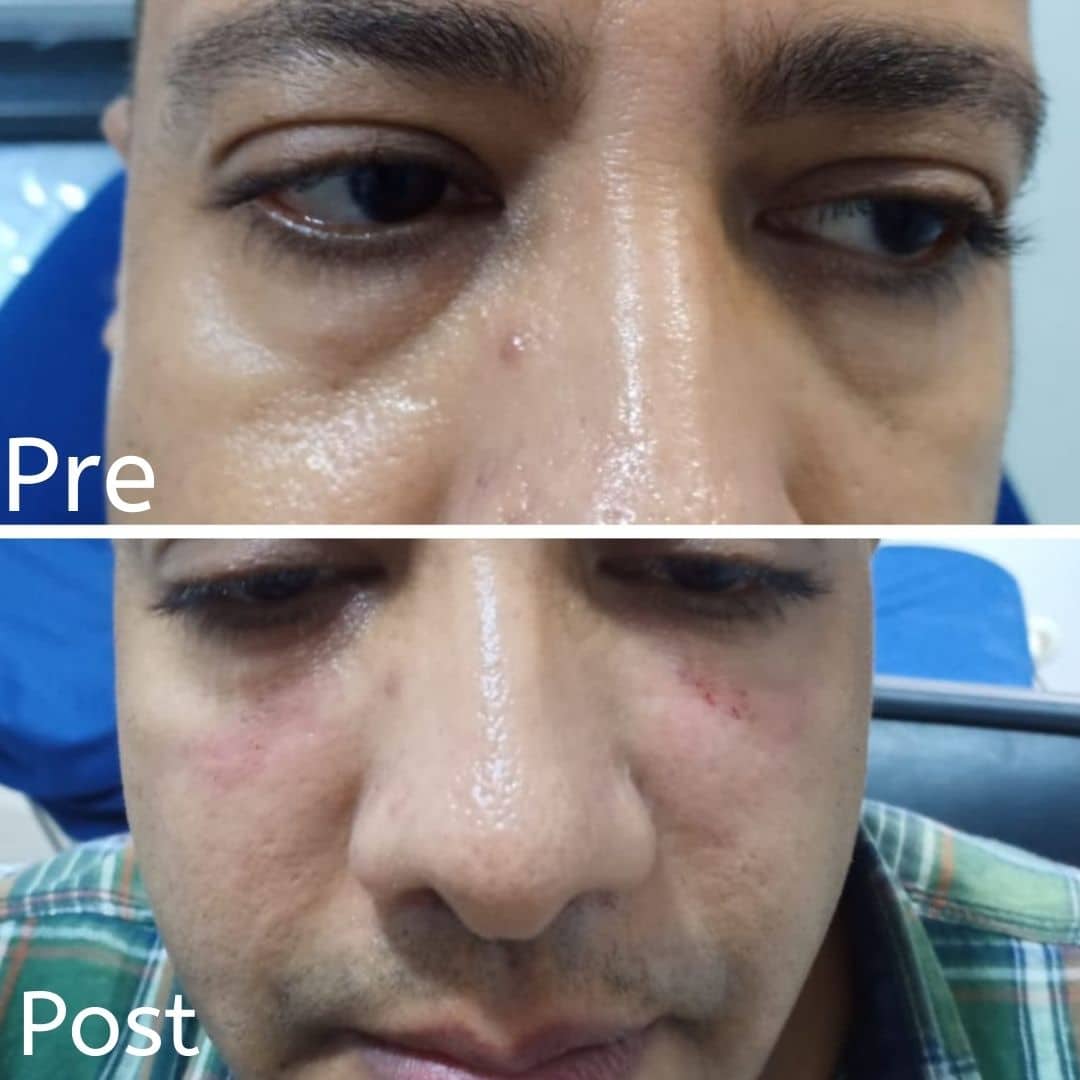 علاج انتفاخات العين